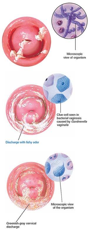 Bacterial Vaginosis Treatment