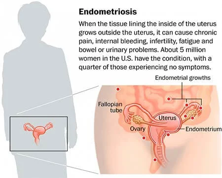 Endometriosis Symptoms