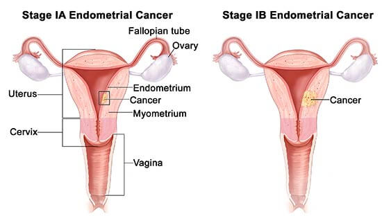 Endometriosis stage 1a vs 1b