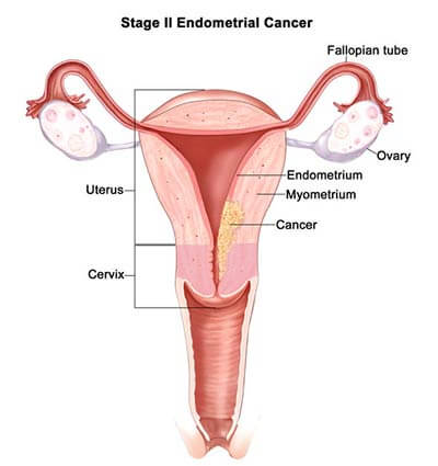 Endometriosis stage 2