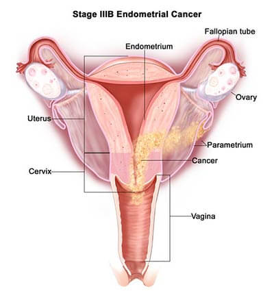 Endometriosis-stage-3