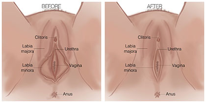 Labia Surgery 