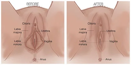 Labiaplasty Brooklyn, NY | Aesthetic Vaginal Surgery Downtown Brooklyn