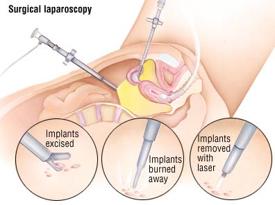 Laparoscopic Treatment of Endometriosis