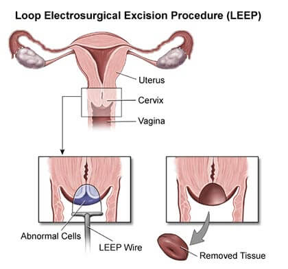 Loop Electrosurgical Excision Procedure (LEEP)