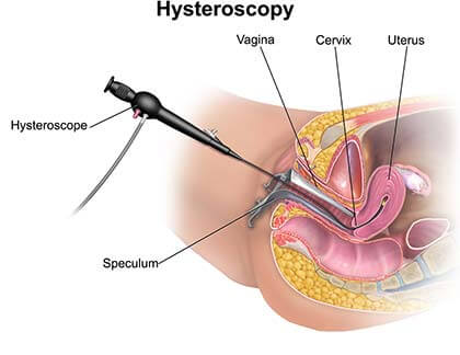 Sonohysterogram Hysterosonogram