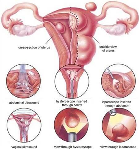 Hysteroscopic Myomectomy fibroids treatment Brooklyn